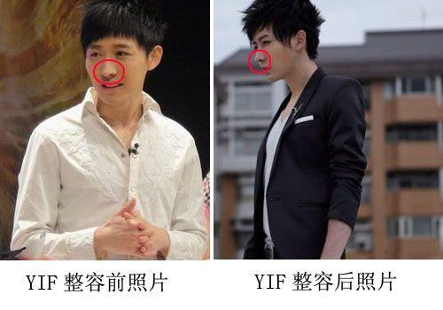 yif整容，整容后遗症,本文共（482字）