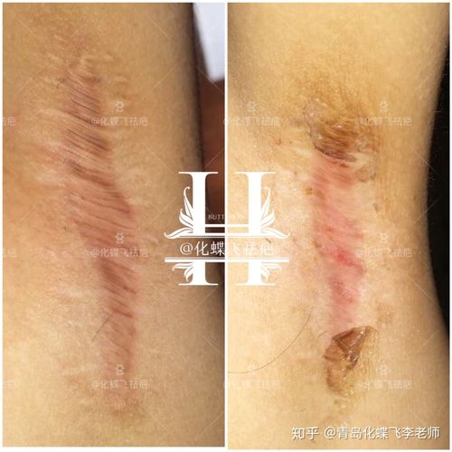 张梓琳腋下现疤痕，腋下有疤痕可能(腋下两道疤痕)