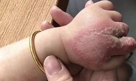 怎么判断是不是被隐翅虫咬了(怎么判断是不是被隐翅虫咬了用牙膏)