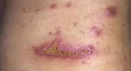 怎么判断是不是被隐翅虫咬了(怎么判断是不是被隐翅虫咬了用牙膏)