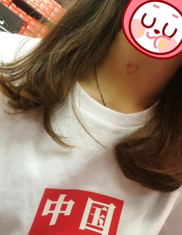 用什么借口来掩饰脖子上的草莓印,什么化妆品能遮草莓印？　本文共（972字）