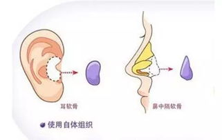 打耳骨钉的安全位置图,打不好耳骨钉有什么危险？　本文共（1026字）