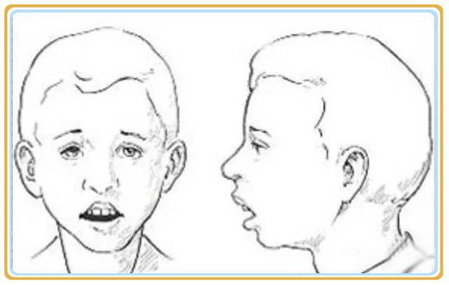 口呼吸面容的经典样子图片,张嘴呼吸变丑能恢复吗？　本文共（1120字）