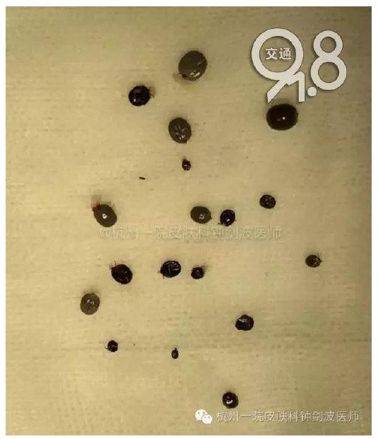 蜱虫为什么能咬死人,被蜱虫咬了怎么处理最安全？　本文共（1132字）
