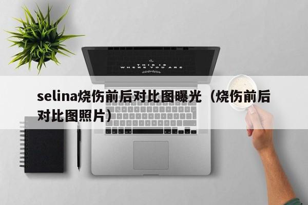 selina烧伤前后对比图曝光（烧伤前后对比图照片） 