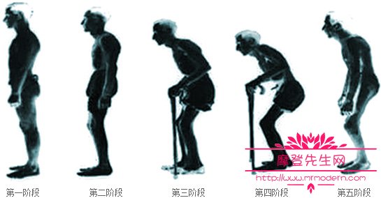 周杰伦的病影响他的寿命吗？强直性脊椎炎的(周杰伦有强制性脊柱炎吗)
